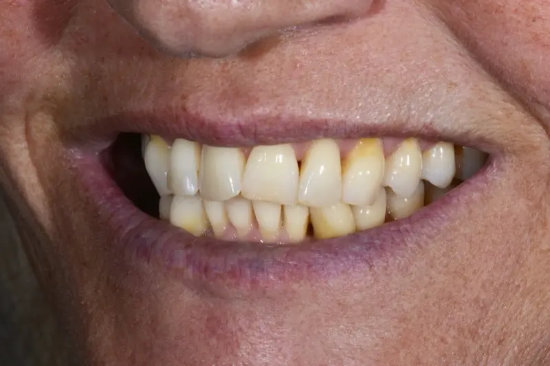 Composite Bonding (1)-2 Composite Bonding (1)-2