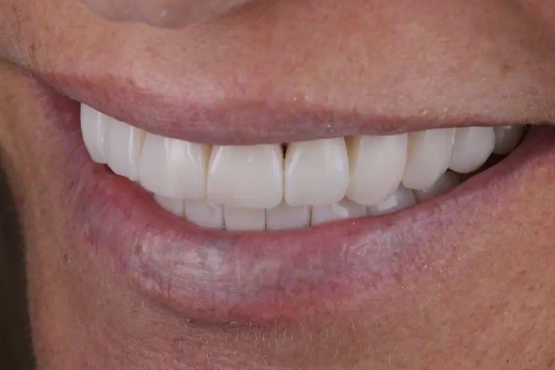 Composite Bonding IMG 9071-2 Composite Bonding IMG 9071-2