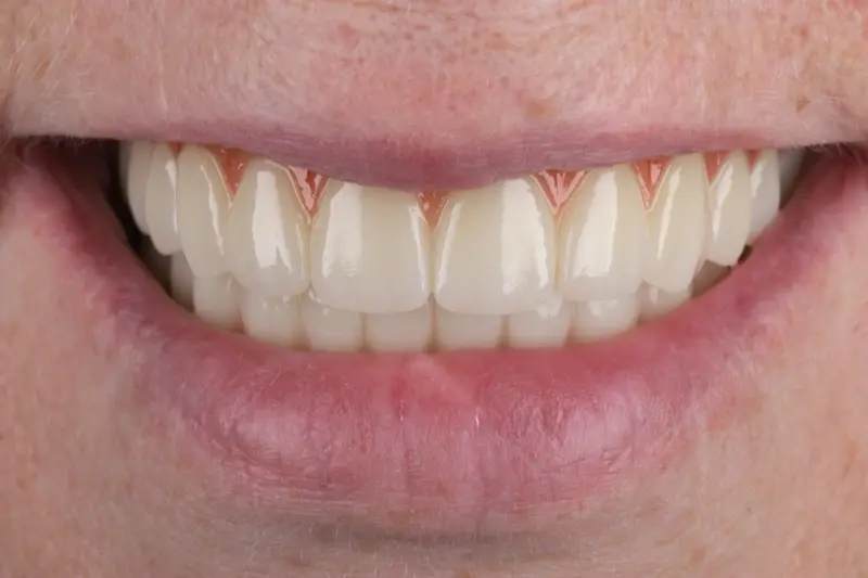 Implants JN Teeth-2 Implants JN Teeth-2