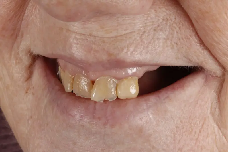 Implants dents même jour-2 Implants dents même jour-2