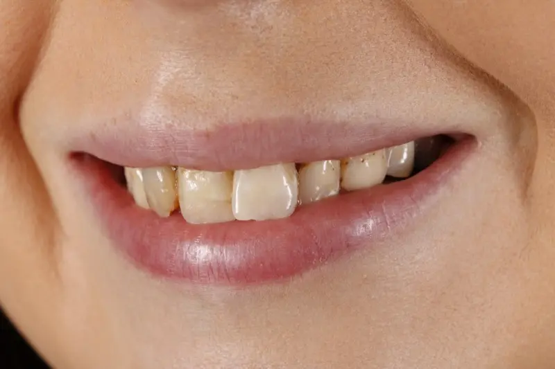 Porcelain Veneers Makeover-2 Porcelain Veneers Makeover-2
